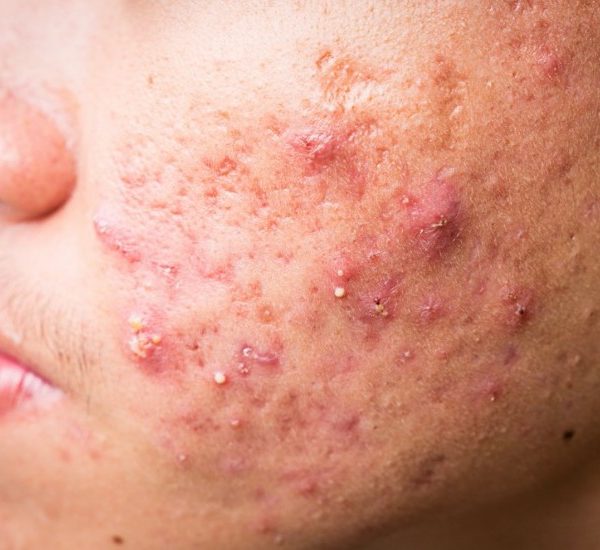 Tratamiento acne dermatologo latacunga (1)