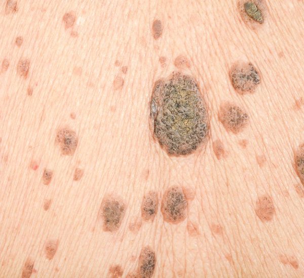 lunares extraccion dermatologo latacunga1