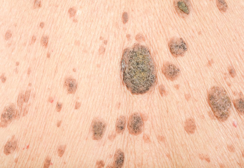lunares extraccion dermatologo latacunga1